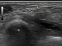 Ulnar Nerve Block Technique: Approach Considerations, Above the Elbow ...