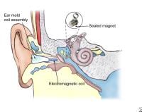 Hearing Impairment