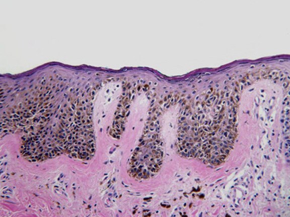 Lentiginous Junctional Nevus Pictures Photos