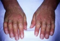 Systemic Sclerosis Clinical Presentation: History, Physical, Causes