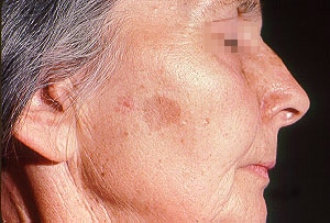 Liver spots, tan macues that develop due to sun exposure that are benign