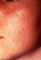 Acne Vulgaris Clinical Presentation