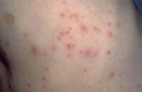 Folliculitis Clinical Presentation