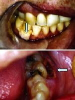 Noncandidal Fungal Infections of the Mouth Clinical Presentation