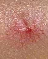 Nevus Araneus (Spider Nevus)