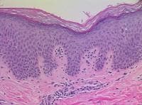 Confluent and Reticulated Papillomatosis Workup