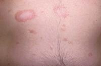 Pityriasis Rosea Clinical Presentation