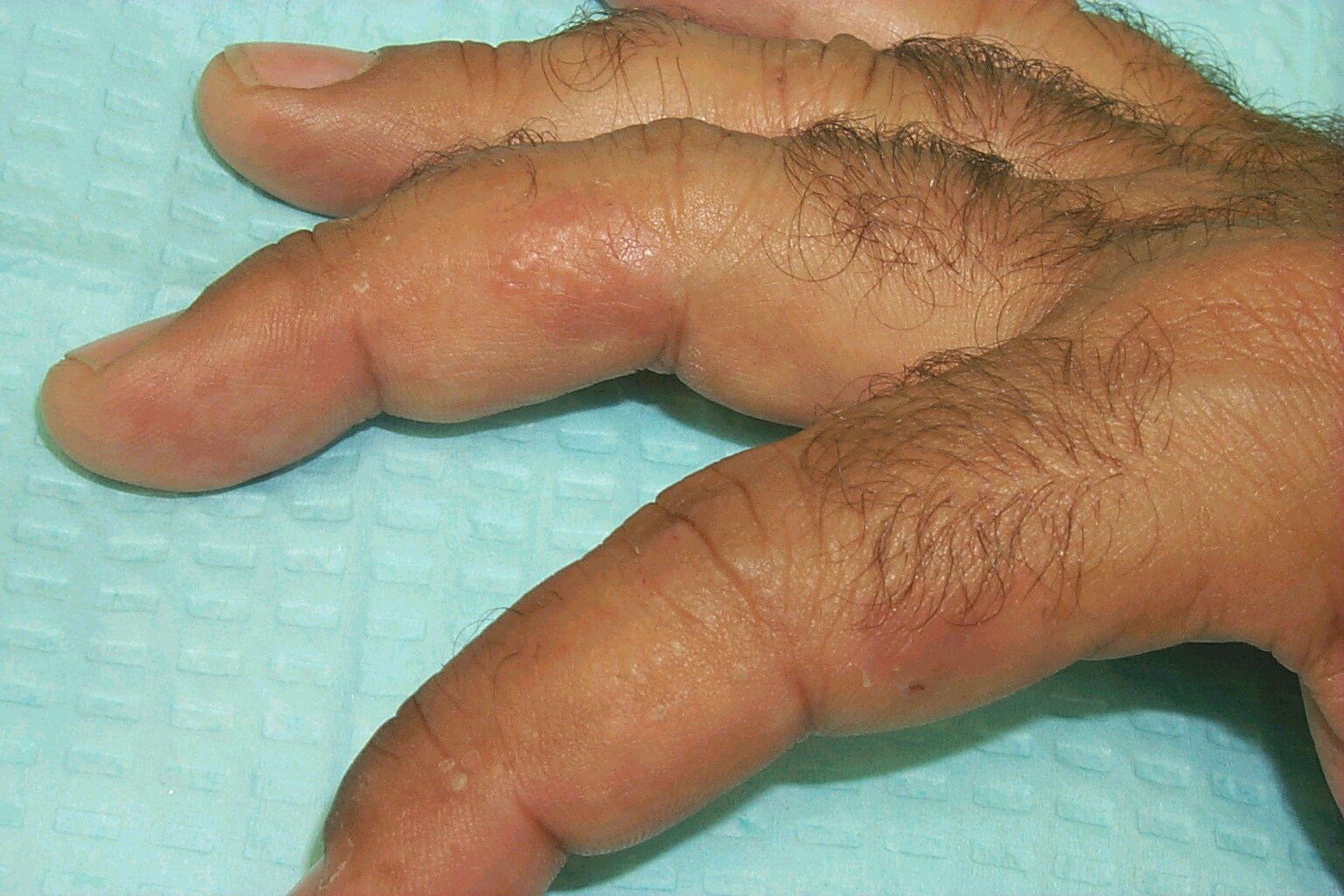 hands looks very much like  dyshidrotic eczema /  dyshidrosis