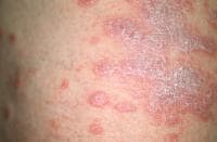 Lichen Planus Clinical Presentation