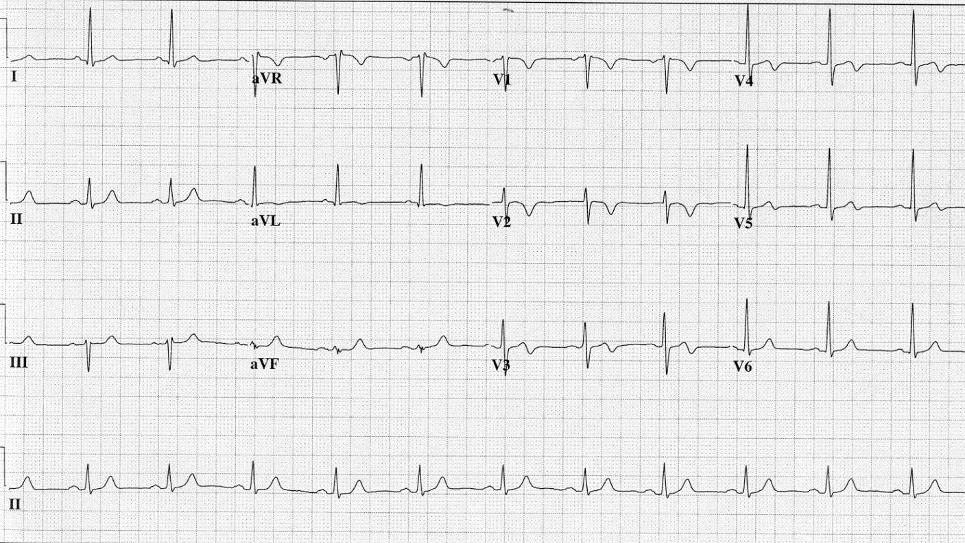 Ekg T Wave