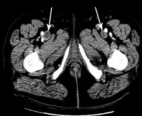 Deep Venous Thrombosis