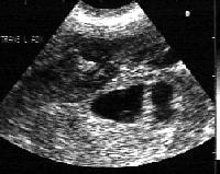 Emergent Management of Ectopic Pregnancy