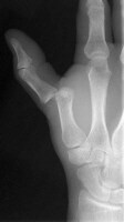Emergent Management of Hand Dislocation