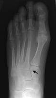 Foot Fracture Treatment & Management: Prehospital Care, Emergency ...