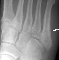 Jones Fracture Treatment