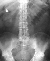 Toxic Megacolon Workup: Approach Considerations, Radiography ...