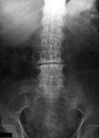 Ileus Differential Diagnoses