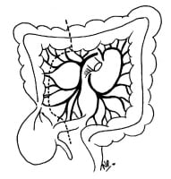 Sigmoid and Cecal Volvulus Treatment & Management