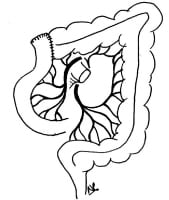 Sigmoid and Cecal Volvulus Treatment & Management