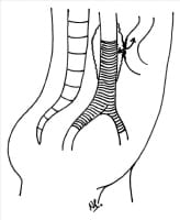 Intestinal Fistula Surgery