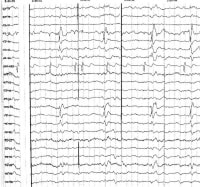 EEG : Normal Values &amp; Results (Electroencephalogram, Brain