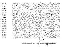 EEG in Common Epilepsy Syndromes: Role of EEG in Epilepsy Syndromes ...