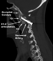 Spinal Instability and Spinal Fusion Surgery Treatment & Management ...