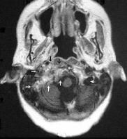 Glomus Tumors Treatment & Management