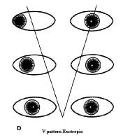 V-Pattern Esotropia and Exotropia: Background, Pathophysiology ...