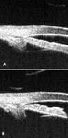 Plateau Iris Glaucoma Workup