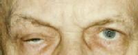 Adult Ptosis Treatment & Management