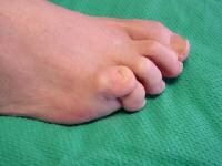 Fifth-Toe Deformities: Background, History of the Procedure, Problem