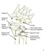 Distal-Third Forearm Fractures: Background, Etiology, Pathophysiology