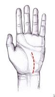 Median Nerve Entrapment Treatment & Management