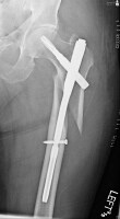 Subtrochanteric Hip Fractures Treatment & Management