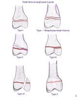 Pediatric Femur Fractures: Overview, Anatomy, Pathophysiology