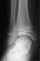 Fibular Hemimelia Workup: Imaging Studies