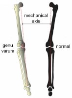 Pediatric Genu Varum: Overview, Pathophysiology, Etiology