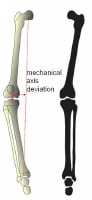 Pediatric Genu Varum: Overview, Pathophysiology, Etiology