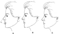 Short Nose Rhinoplasty