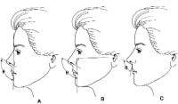 Short Nose Rhinoplasty