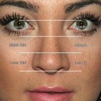 Prerhinoplasty Facial Analysis: Overview, The Aesthetic Ideal, History