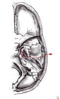 Unstable Fracture Treatment | Bone Fracture Treatment Blog