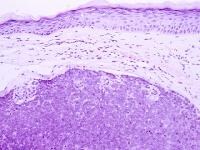 Merkel Cell Tumors of the Head and Neck: Overview, Pathophysiology and ...