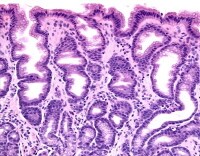 Pathology of Reactive Gastropathy