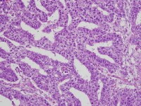 Pathology of Embryonal Carcinoma: Definition, Epidemiology, Etiology