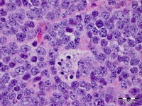 Toxoplasmosis Pathology