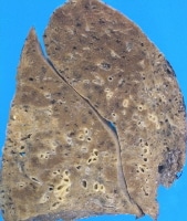 Honeycomb Lung Pathology