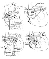 Surgical Approach to Partial and Total Anomalous Pulmonary Venous ...