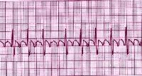 Pediatric Atrial Flutter Workup